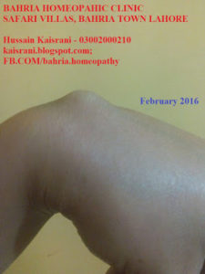 bahria homeopathic clinic safari villas bahria town lahore hussain kaisrani phone 03002000210 homeopathic treatment of ganglion cyst on wrist 1