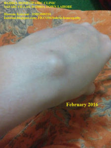 bahria homeopathic clinic safari villas bahria town lahore hussain kaisrani phone 03002000210 homeopathic treatment of ganglion cyst on wrist 2