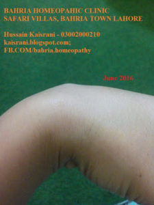bahria homeopathic clinic safari villas bahria town lahore hussain kaisrani phone 03002000210 homeopathic treatment of ganglion cyst on wrist 3