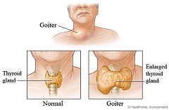 Nodular goitre of a young south asian woman.