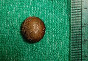 Bladder stones incidentally found in a bladder diverticulum during transvesical prostatectomy (removal of the prostate via an incision in the bladder).