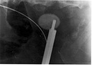 A kidney stone at the tip of an ultrasonic instrument.