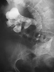 Staghorn calculus (struvite stone)