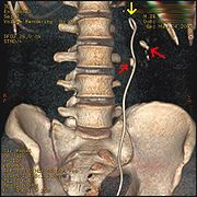 Three-dimensional reconstructed CT scan image of a ureteral stent in the left kidney (indicated by yellow arrow). There is a kidney stone in the pyelum of the lower pole of the kidney (highest red arrow) and one in the ureter beside the stent (lower red arrow).