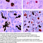 Systemic lupus erythematosus – Homeopathy Treatment and Homeopathic Remedies