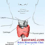 A homeopathic treatment of Hoarseness – A Causticum case