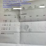 Homeopathic Treatment for Typhoid Fever – Step by Step Case Study – Hussain Kaisrani