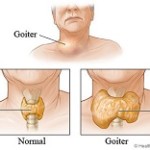 Goitre – Homeopathy Treatment and Homeopathic Remedies