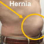 <font face="jameel noori nastaleeq"> ہرنیا ۔ فتق: ہومیوپیتھک علاج – حسین قیصرانی HERNIA – Homeopathy Treatment and Homeopathic Remedies Urdu