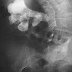 Kidney stone – Homeopathy Treatment and Homeopathic Remedies