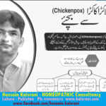 <font face="jameel noori nastaleeq">چکن پاکس، لاکڑا کاکڑا کیا ہے اور ہومیوپیتھک علاج کیا۔ حسین قیصرانی۔